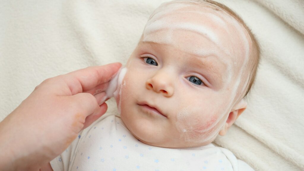 Applying curing lotion or ointment on baby cheeks suffering from dermatitis and acne. Concept of